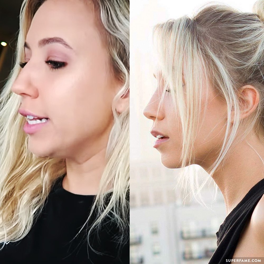 Kalel Kitten Reveals Her Amazing New Nose After Plastic